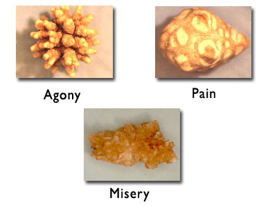 File:Kidney stones.jpg