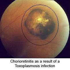 File:1083 Toxoplasmosis Retina.jpg